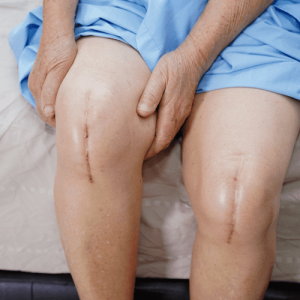 Total Knee Arthroplasty