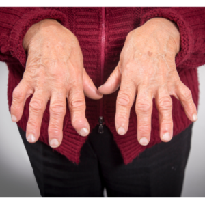 rheumatoid arthritis