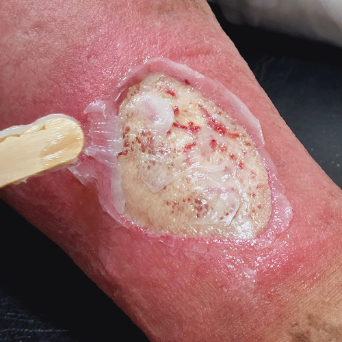 pressure ulcer