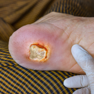 pressure ulcer