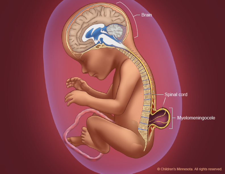 spina bifida